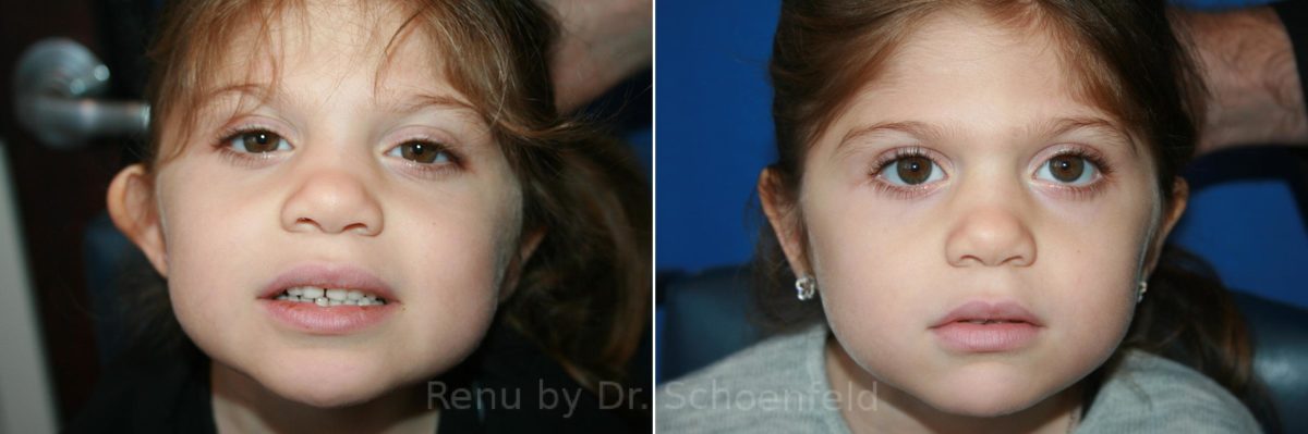 Otoplasty Before and After Photos in DC, Patient 8693