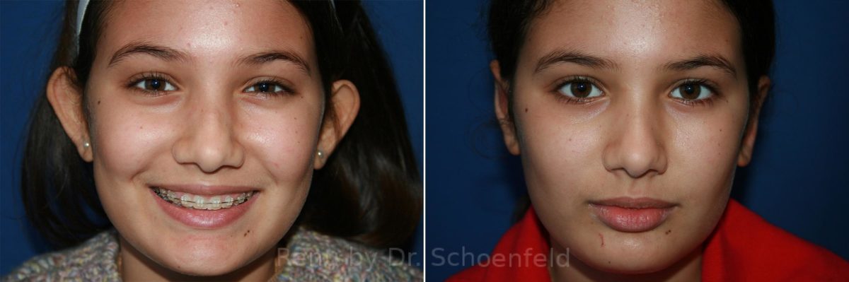 Otoplasty Before and After Photos in DC, Patient 8821