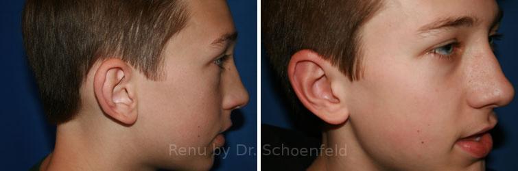 Otoplasty Before and After Photos in DC, Patient 7476