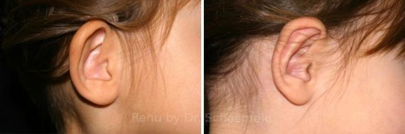Otoplasty Before and After Photos in Chevy Chase, MD