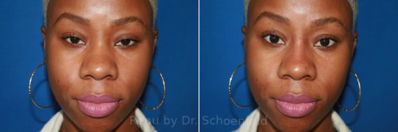 Non-Surgical Rhinoplasty Before and After Photos in DC, Patient 8655