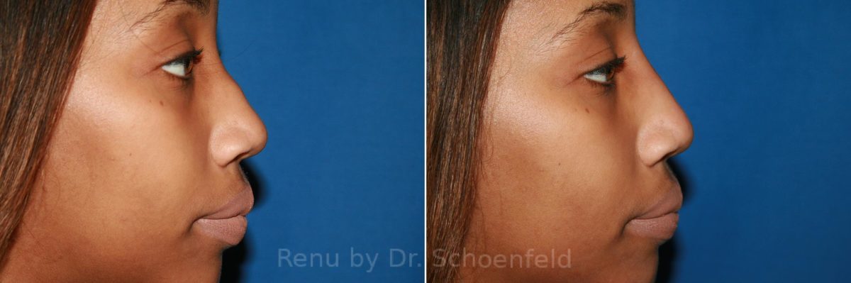 Non-Surgical Rhinoplasty Before and After Photos in DC, Patient 9038