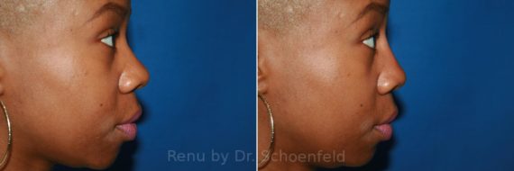 Non-Surgical Rhinoplasty Before and After Photos in DC, Patient 8655