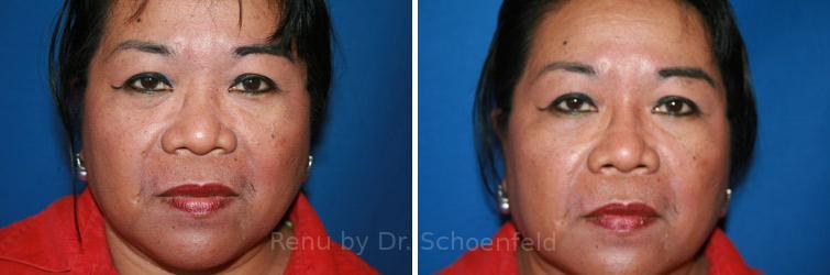 Non-Surgical Rhinoplasty Before and After Photos in DC, Patient 7461