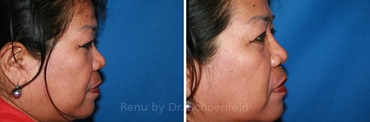 Non-Surgical Rhinoplasty Before and After Photos in DC, Patient 7461