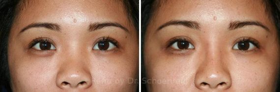 Non-Surgical Rhinoplasty Before and After Photos in DC, Patient 7466