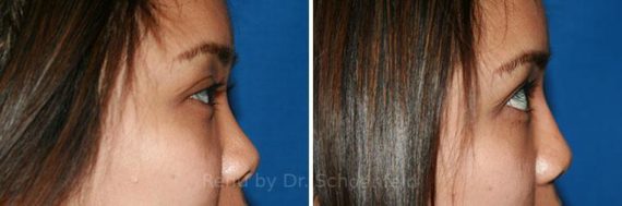 Non-Surgical Rhinoplasty Before and After Photos in DC, Patient 7466