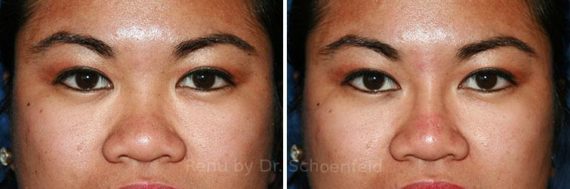 Non-Surgical Rhinoplasty Before and After Photos in Chevy Chase, MD