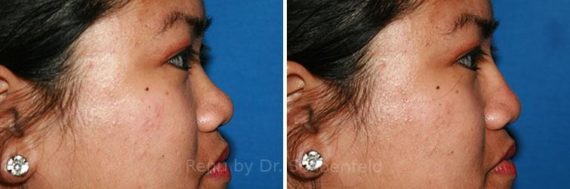 Non-Surgical Rhinoplasty Before and After Photos in Chevy Chase, MD