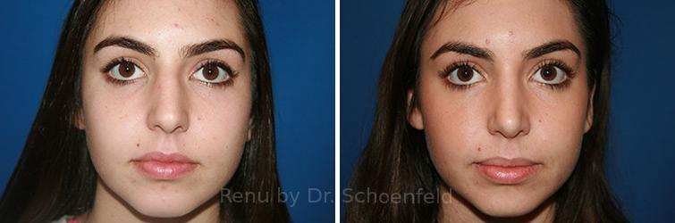 Rhinoplasty Before and After Photos in DC, Patient 7716