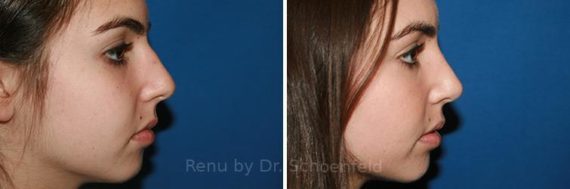 Rhinoplasty Before and After Photos in DC, Patient 7716