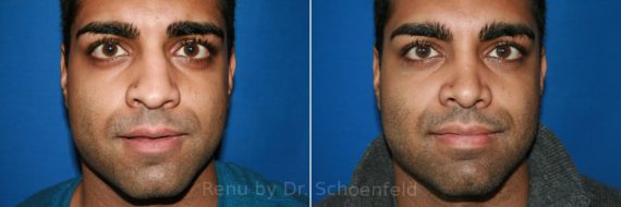 Rhinoplasty Before and After Photos in DC, Patient 8603