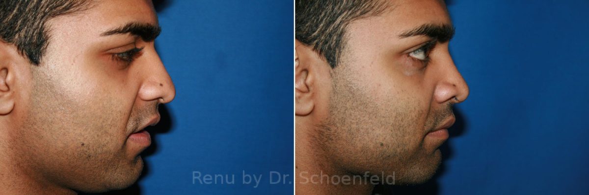 Rhinoplasty Before and After Photos in DC, Patient 8603