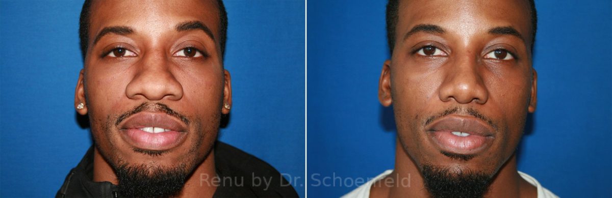 Rhinoplasty Before and After Photos in DC, Patient 8534