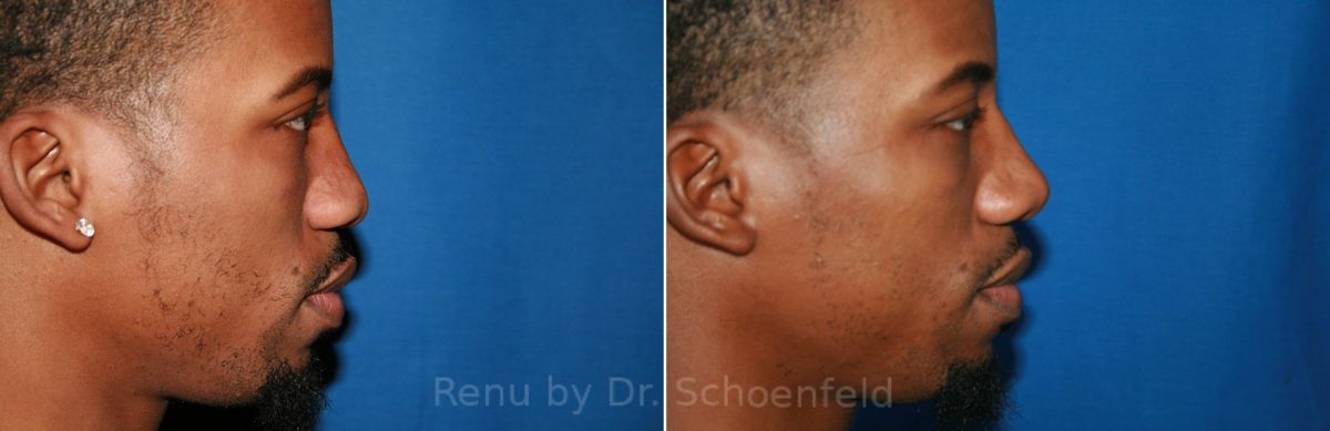Rhinoplasty Before and After Photos in DC, Patient 8534