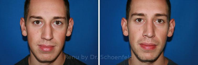 Rhinoplasty Before and After Photos in DC, Patient 7576