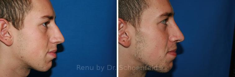 Rhinoplasty Before and After Photos in DC, Patient 7576