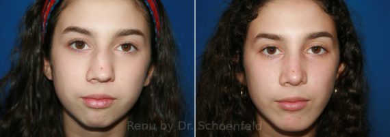 Rhinoplasty Before and After Photos in DC, Patient 9888