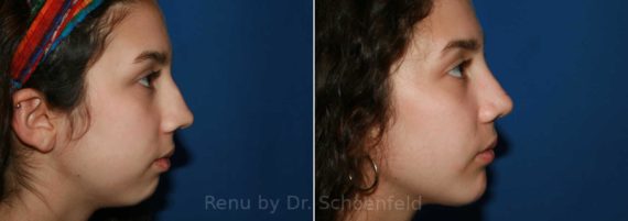 Chin Implant Before and After Photos in DC, Patient 9888