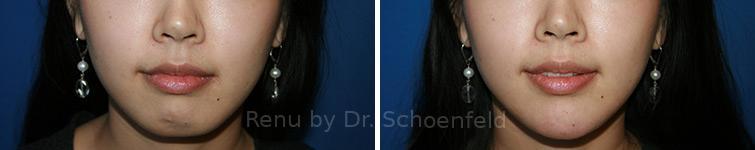 Chin Implant Before and After Photos in DC, Patient 7333