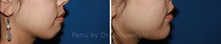 Chin Implant Before and After Photos in DC, Patient 7333