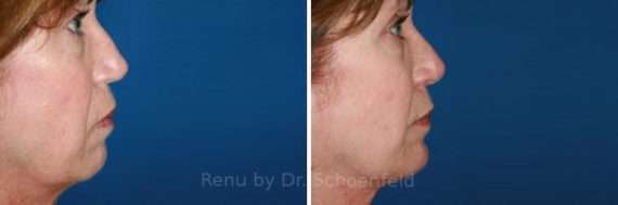 Chin Implant Before and After Photos in DC, Patient 7314