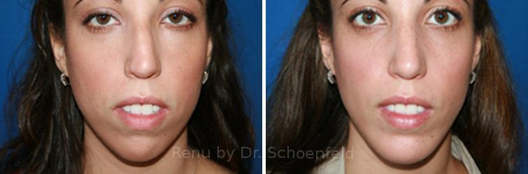 Chin Implant Before and After Photos in DC, Patient 7317