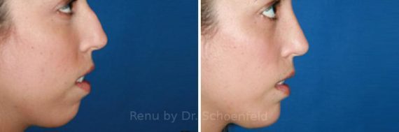Chin Implant Before and After Photos in DC, Patient 7317