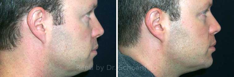Chin Implant Before and After Photos in DC, Patient 7322