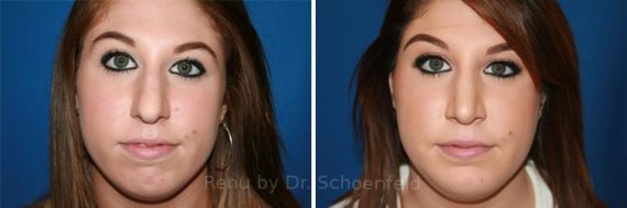 Chin Implant Before and After Photos in DC, Patient 7338