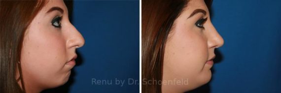 Chin Implant Before and After Photos in DC, Patient 7338