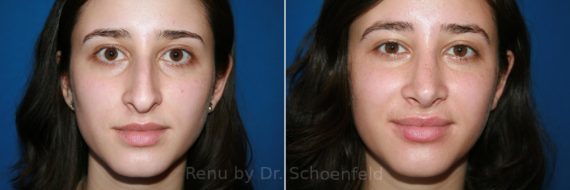 Rhinoplasty Before and After Photos in DC, Patient 9517