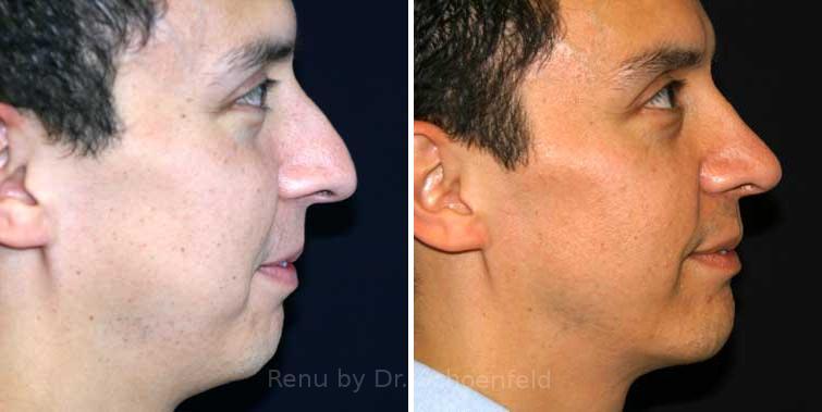 Chin Implant Before and After Photos in DC, Patient 7325