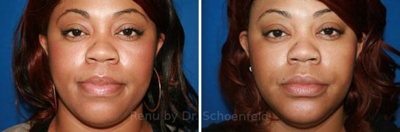 Chin Implant Before and After Photos in DC, Patient 7328