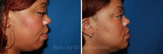 Chin Implant Before and After Photos in DC, Patient 7328