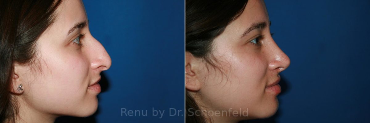 Rhinoplasty Before and After Photos in DC, Patient 9517