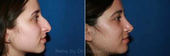 Rhinoplasty Before and After Photos in DC, Patient 9517