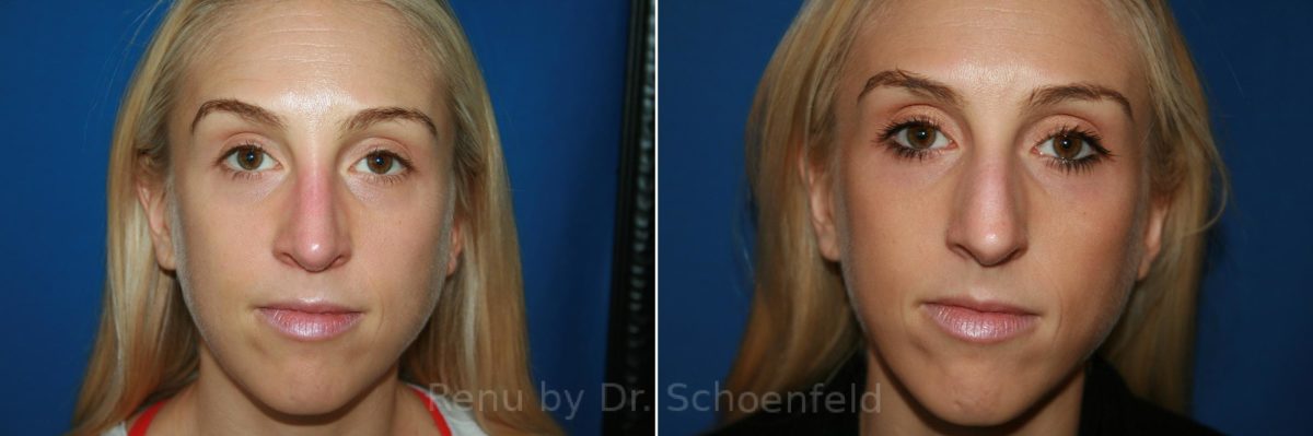 Rhinoplasty Before and After Photos in DC, Patient 9364