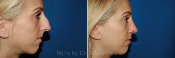 Rhinoplasty Before and After Photos in DC, Patient 9364