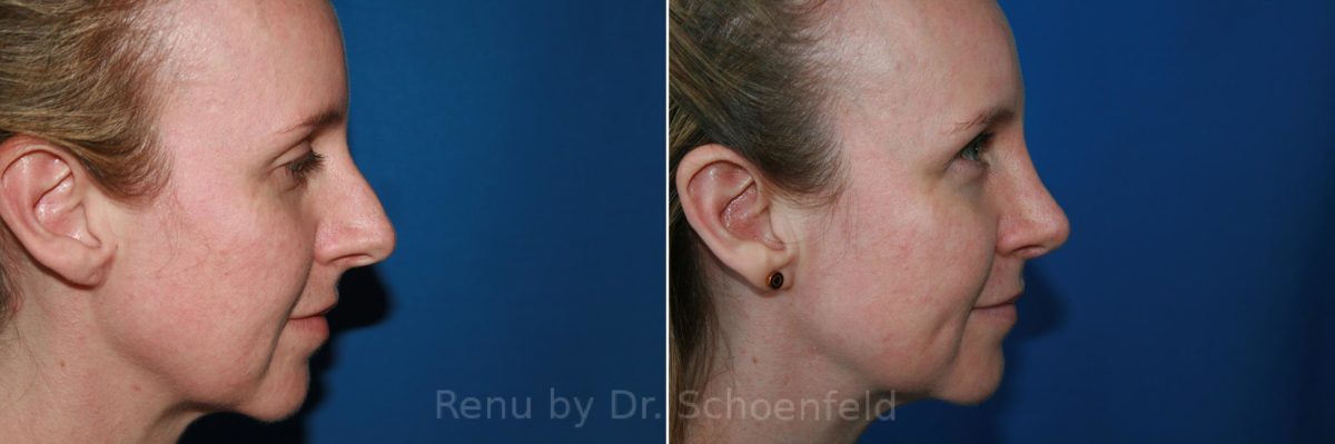 Rhinoplasty Before and After Photos in DC, Patient 9235