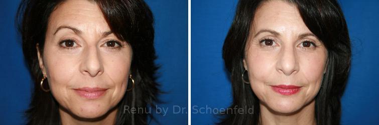 Rhinoplasty Before and After Photos in DC, Patient 7581
