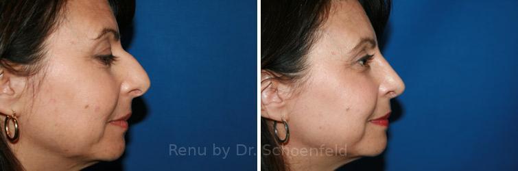Rhinoplasty Before and After Photos in DC, Patient 7581