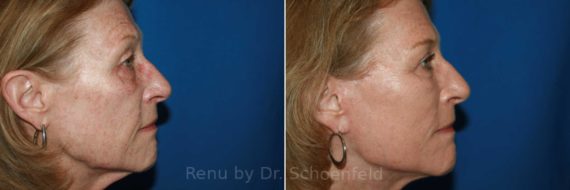 Facelift Before and After Photos in DC, Patient 9902
