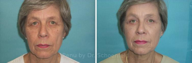 Facelift Before and After Photos in DC, Patient 7418
