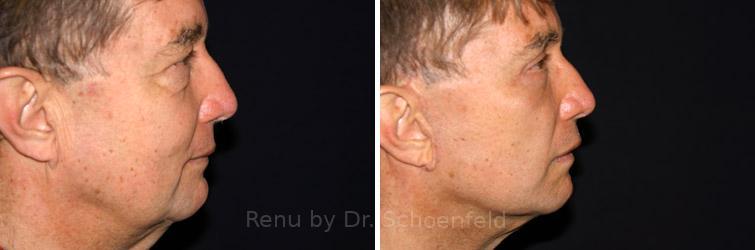 Facelift Before and After Photos in DC, Patient 7421