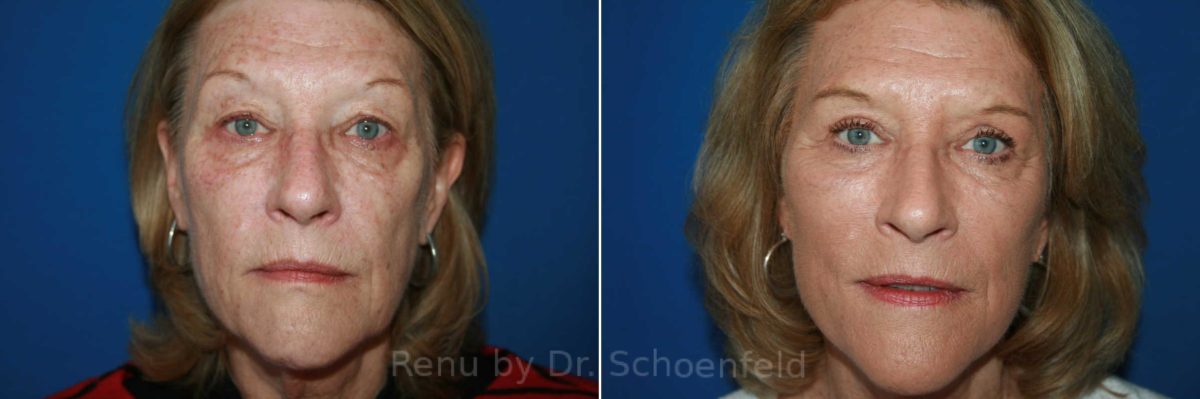 Facelift Before and After Photos in DC, Patient 9902