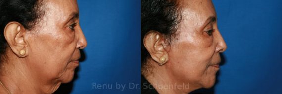 Facelift Before and After Photos in DC, Patient 8614