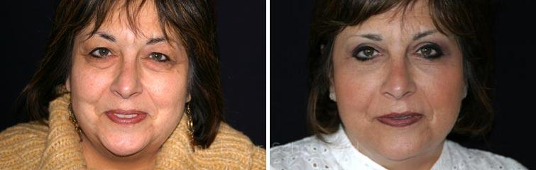 Facelift Before and After Photos in DC, Patient 7426