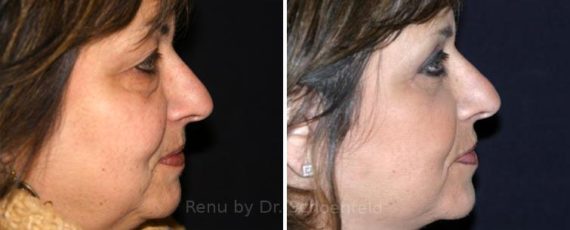 Facelift Before and After Photos in DC, Patient 7426