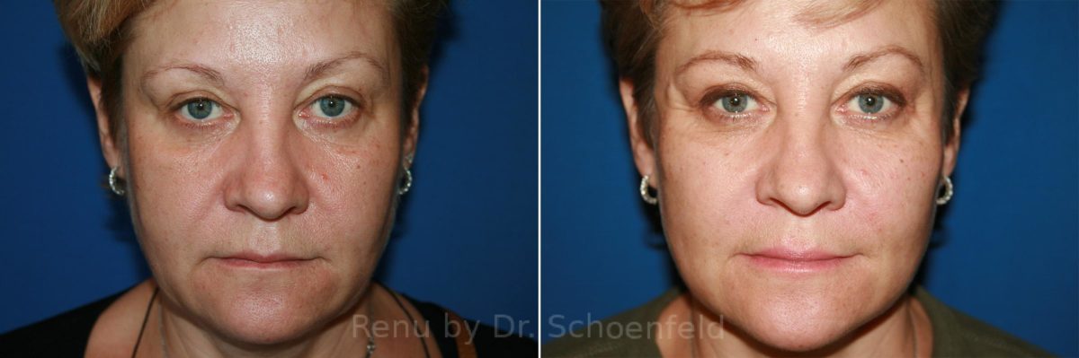 Facelift Before and After Photos in DC, Patient 8814